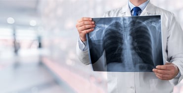 ¿El cáncer de pulmón es hereditario? Entérate aquí